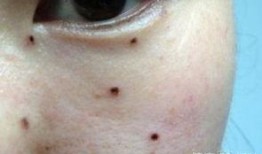 给吃瓜男孩点痣视频,颜值飙升！